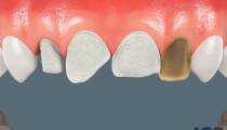 ونیر | کلینیک دندانپزشکی تاج