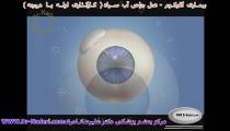 درمان آب سیاه با کارگذاری شانت - مرکز چشم پزشکی دکتر علیرضا نادری