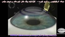 کار گذاری رینگ داخل قرنیه به روش معمول - مرکز چشم پزشکی دکتر علیرضا نادری
