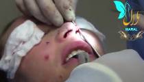 جراحی بینی | فیلم جراحی بینی | کلینیک پوست و مو مارال | شماره 3