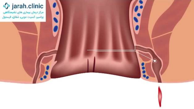 پیشگیری از ابتلا به فیستول در کلینیک نوین