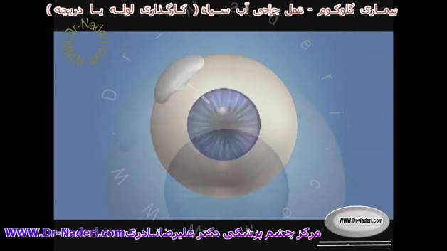 درمان آب سیاه با کارگذاری شانت - مرکز چشم پزشکی دکتر علیرضا نادری