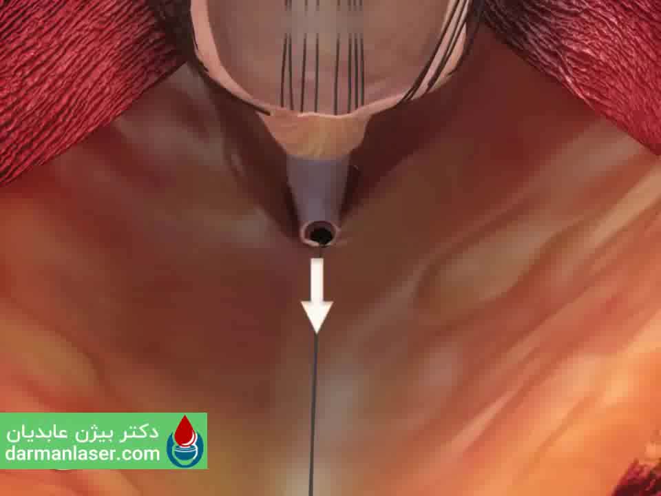 تشخیص علایم و نشانه های فیستول مقعدی (آبسه) توسط دکتر بیژن عابدیان